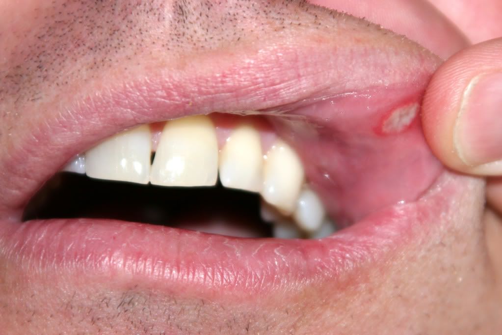 Canker In Throat