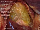 th_Pericardium.jpg
